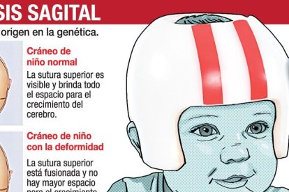 Diferencia entre caso normal y caso de craneostosis