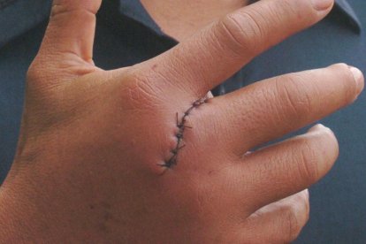 Una herida de 10 centímetros le quedó luego de recibir el machetazo.