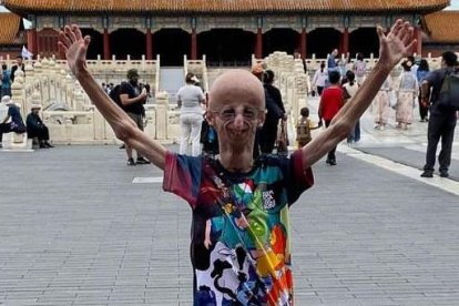 Padecía el Síndrome de Progeria de Hutchinson-Gilford