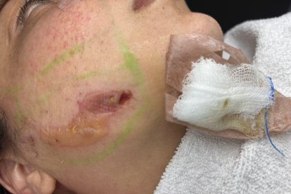 La cicatriz que le dejó la operación a Denisse Díaz.