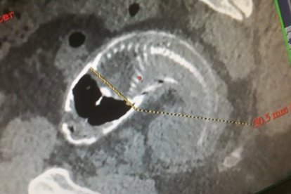 La tilapia habría perforado parte del intestino grueso del hombre.