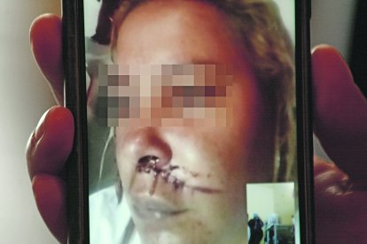 Nicole mostró sus heridas por videollamada. Tiene 28 días de incapacidad.
