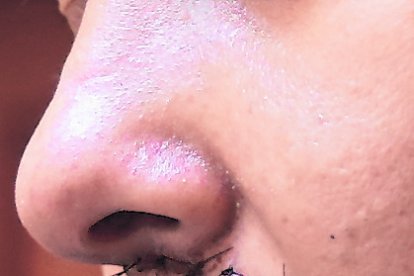 El corte en el labio no le permite comer normalmente.