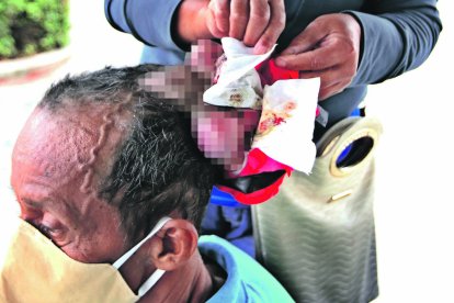 El tumor que tiene José Ríos en la cabeza es casi del tamaño de un melón.
GERARDO MENOSCAL
Agencia (ag-expreso)