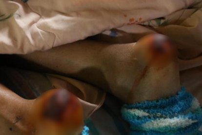 Por las heridas en sus tobillos la joven no puede caminar.