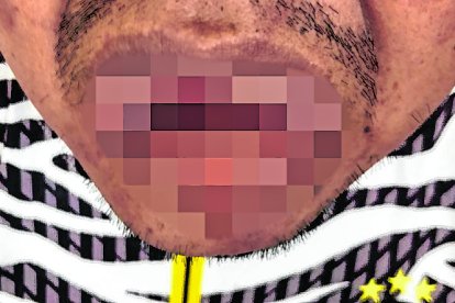 Ítalo Cruz Matías perdió parte de su lengua. También presenta heridas en sus manos.