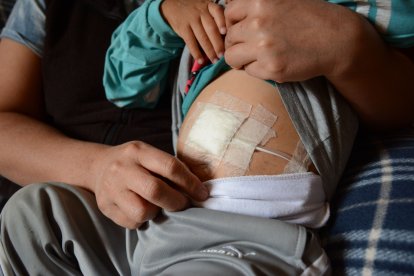 Los catéteres en su abdomen deben ser cambiados todos los días.