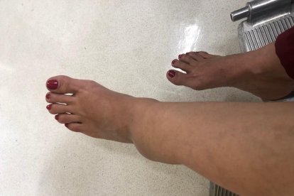 Pie fracturado de la presentadora.