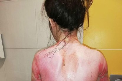 Su espalda se puede ver roja y en carne viva por las quemaduras graves.