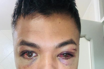 La víctima recibió varios golpes en la cara.