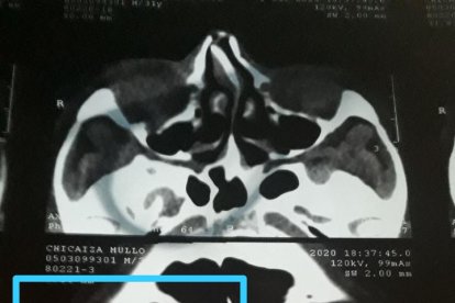 Esta radiografía muestra la magnitud de la agresión.