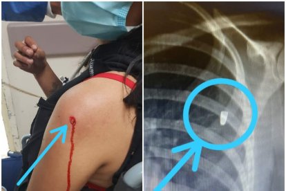 El proyectil se alojó en el brazo de la joven.