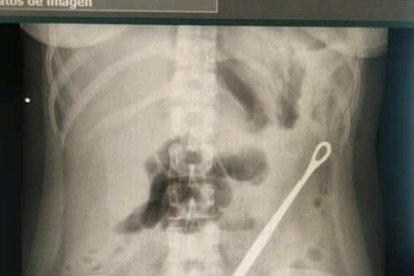 En esta radiografía se observa el objeto que fue olvidado en el vientre de Litsy.