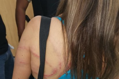 Foto de los latigazos que una mujer sufrió en el año 2019, el agresor fue su pareja.