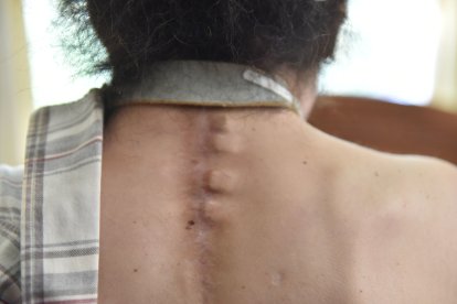 En su espalda se puede ver la herida de una de sus 10 operaciones.