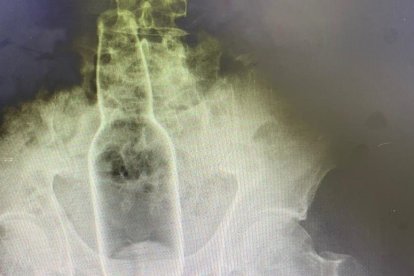 REFERENCIAL: En una radiografía se puede identificar objetos extraños en el cuerpo humano.