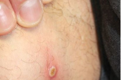 Las pústulas en uno de los infectados y dueños del perro,