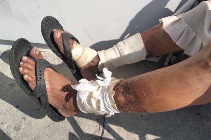 Las venas de María sangraron debido a un golpe que sufrió.