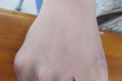 Un derechazo le dio Nicole al desconocido que la atacó. El diente del hombre le habría cortado la piel.