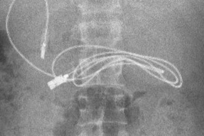 Esta es la radiografía de un adolescente que se tragó un cable.