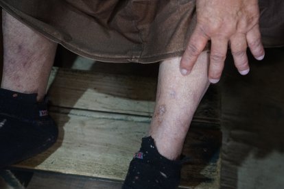La señora muestra las heridas que le ha dejado la diabetes y que muy difícilmente han sanado.