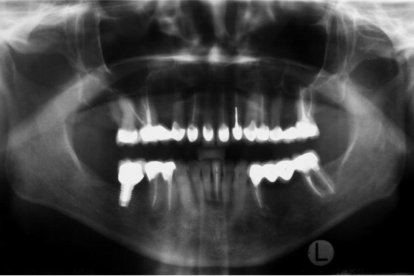 Los profesionales revisan las mordidas en pacientes para ver si se trata de un problema articular.