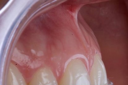 Con plaquitas protectoras procuran que no se agrave el estado de los dientes.