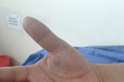 Según el afectado, la amputación se hizo sobre la misma camilla en la que estaba recostado.