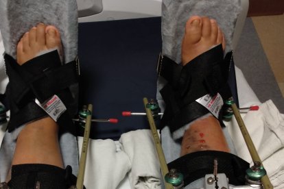 Así quedaron las piernas de la quiteña luego de la intervención quirúrgica.