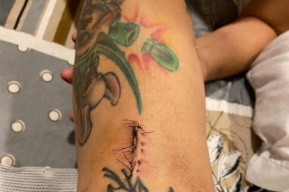 Cicatrices de la operación.