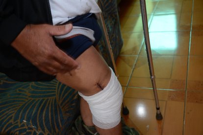 La intervención incluye cambiar las placas de metal  que tiene cerca 
de la rodilla.