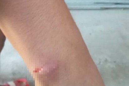 Luis, uno de los últimos afectados por estas prácticas en el país, en 2023, muestra las heridas por el maltrato que recibió.