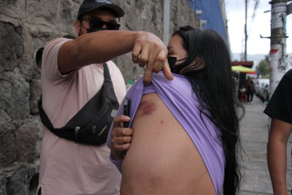 Lina Muñoz mostró los moretones que le dejaron los toletazos.