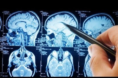 Referencial. Tomografía de persona que padece esclerosis multiple