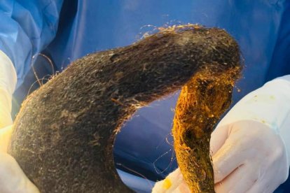 Esto se halló en el estómago de la paciente