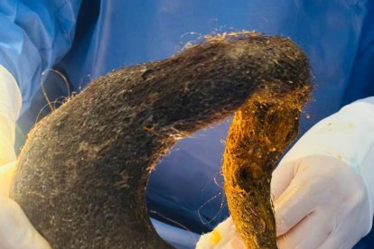 Este fue la bola de pelos encontrada al interior de la mujer.