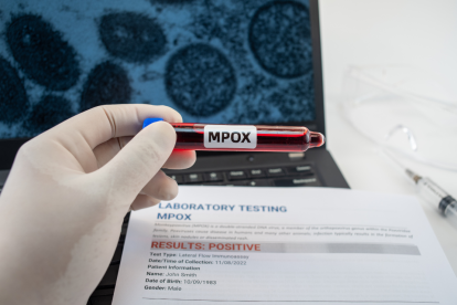 La mpox ha puesto en alerta al mundo.