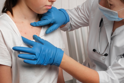 Las erupciones en la piel son el principal síntoma de viruela del mono.