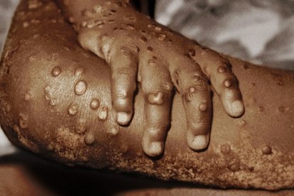 Así se ve la infección de la viruela del mono.