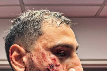 El rostro de Gianluigi Donnarumma luego de ser intervenido por los médicos del PSG