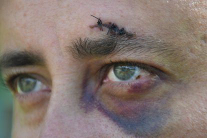 Una de las marcas que le dejó el ataque que sufrió.