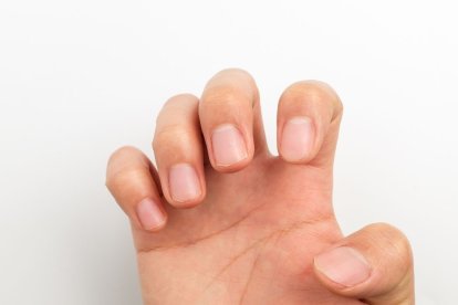 Es recomendable consultar a un dermatólogo.