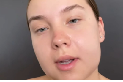 Oana Chelaru, así luce su rostro, tras la cirugía