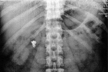 El objeto permanece en su intestino