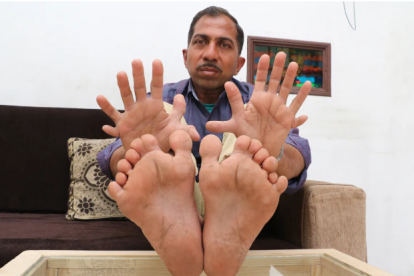 Suthar ha entrado en los Récord Guiness por su condición.