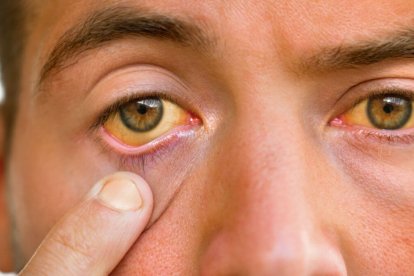 La ictericia (color amarillo en la piel y ojos) a causa del daño hepático es uno de los síntomas de las infecciones graves de fiebre amarilla.