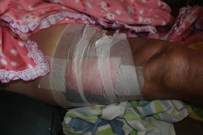 El adulto mayor aún tiene la bala alojada en la pierna derecha.