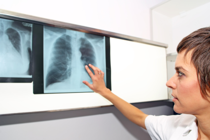 Las radiografías son una de las herramientas clave para detectar signos de hipertensión pulmonar, ayudando a identificar cambios en el tamaño y la forma del corazón y los pulmones.