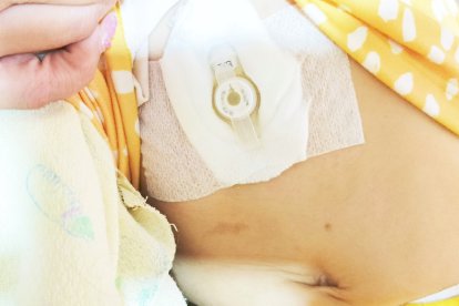 Este es el botón gástrico por el que Fátima puede alimentarse.