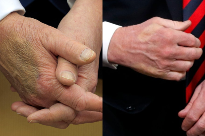 Se ha viralizado en varios medios los moretones de Trump en su mano, que intenta disimularlos con maquillaje